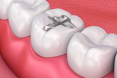 Lake Harris Dental | All-on-6, Dentures and Botox reg 