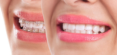 Lake Harris Dental | Dental Bridges, Juvederm reg  and Night Guards