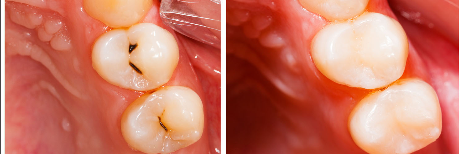The image shows a close-up view of a person s teeth with multiple cavities, emphasizing dental health issues.