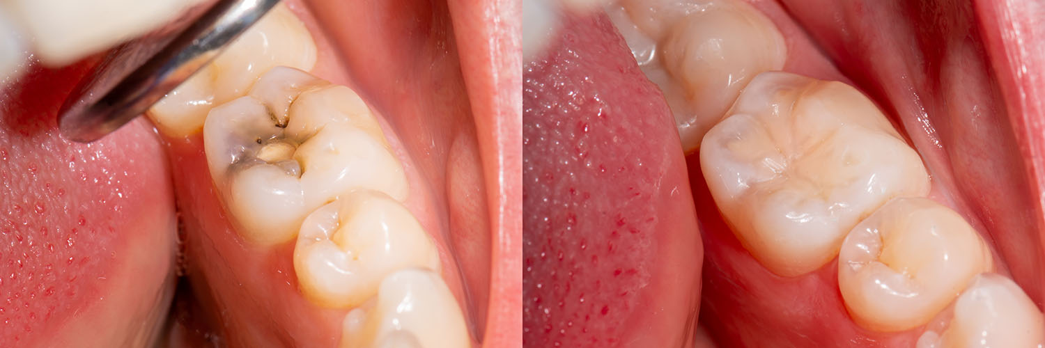 The image shows a close-up view of a mouth with multiple teeth, some of which appear to be damaged or decaying, and there are visible signs of dental work being performed, such as a drill bit in use and a small amount of debris on the teeth.