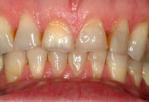 Lake Harris Dental | Dental Bridges, ClearCorrect reg  and All-on-6